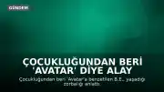 Çocukluğundan Beri 'Avatar' Diye Alay Edilen Kadın: 'Yüzümden Memnunum'